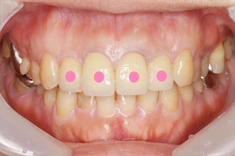 オールセラミック（前歯）の症例