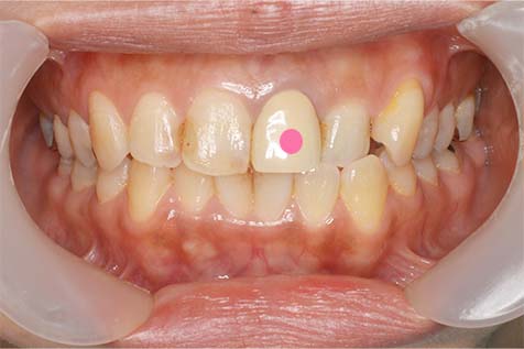 オールセラミック（前歯）の症例