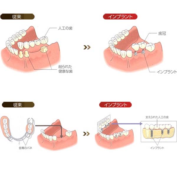 歯を失った後の治療